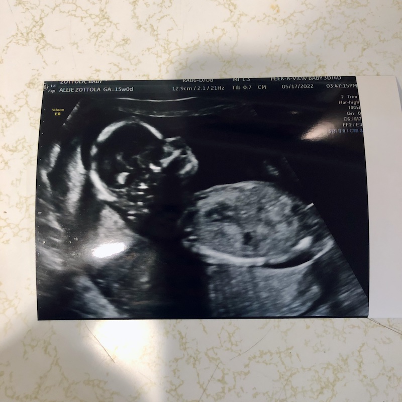 Baby boy 15 week ultrasound